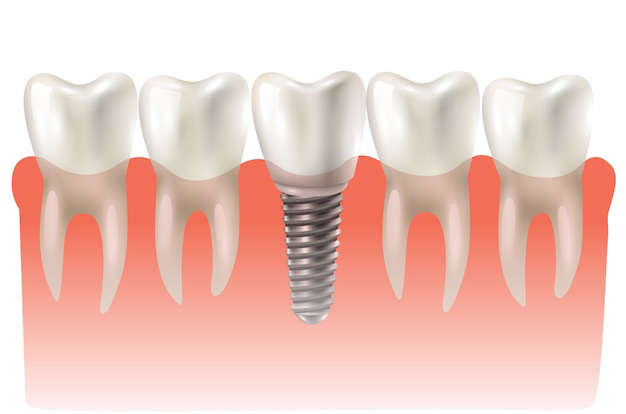 Dental Implant Treatment in Wakad