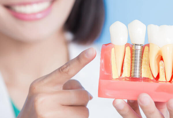 Full Mouth Dental Implants in Wakad