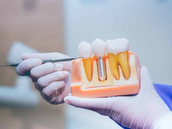 What Are A Few Alternative Options To Dental Implants?