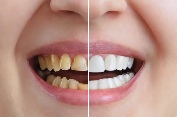 Cosmetic Dentistry and Smile Designing is growing in India