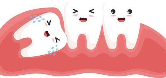 Wisdom Teeth: Understanding The Associated Risks