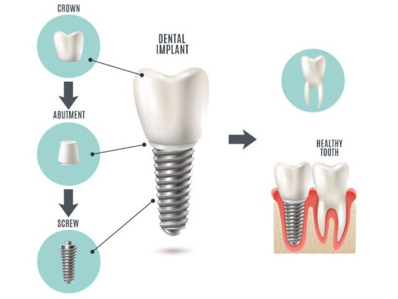 When to Replace a Broken Tooth with Dental Implants