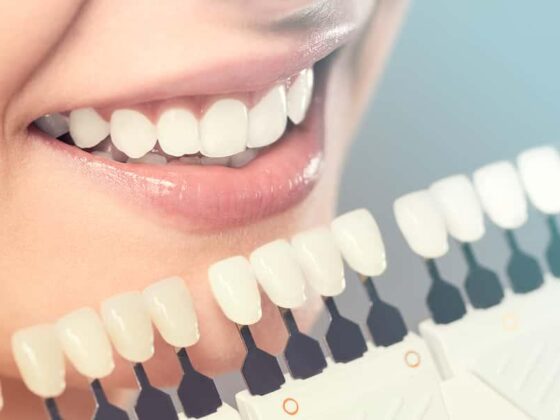 Teeth Whitening – Myths and Facts You Should Know