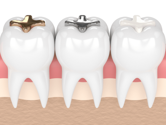The Different Types of Dental Fillings