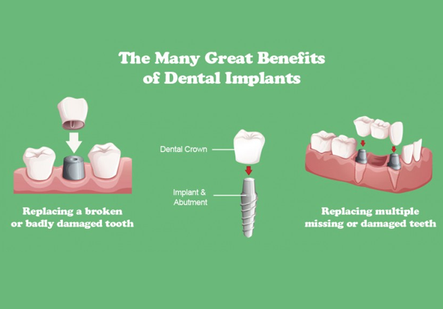 Functional Benefits of Dental Implants | Dentsee Dental Clinic