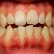 Find Tooth Crowding Solutions
