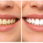Dr. Ankush R. Agrawal providing best dental care and whitening in Wakad