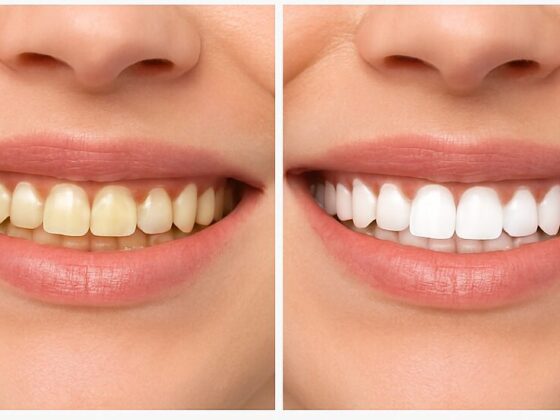 Before and After: Amazing Teeth Whitening Results at Dentsee Wakad